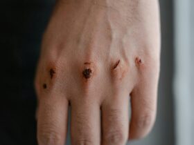 hypochlorous acid wound healing